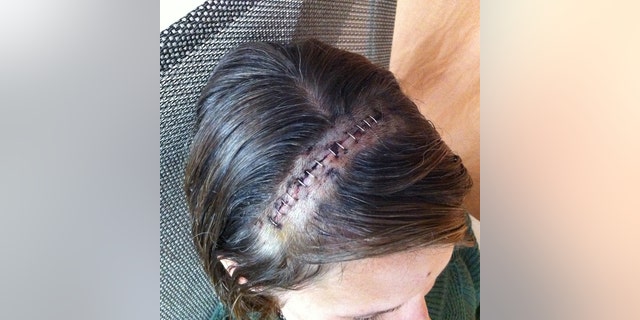 A close-up of Wendi Lou Lees stitches from brain surgery